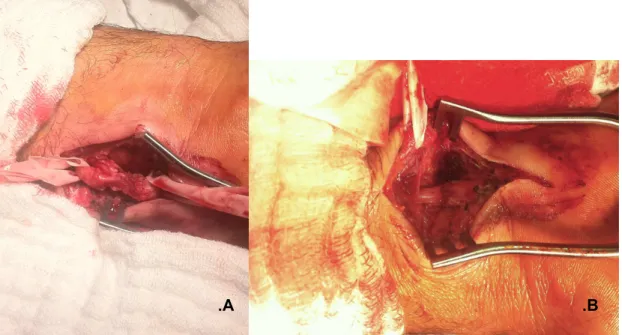 Figura 2:  Lesão do nervo ulnar ao nível do punho em pré e pós-operatório. A. Neurotmese, aspecto  inicial