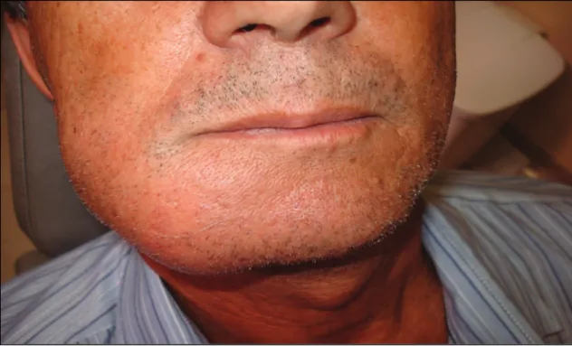 Figura  1  –Aspecto  extra-bucal  do  paciente,  demonstrando  aumento  de  volume  no  terço  inferior do lado direito da face, sem sinais flogísticos evidentes