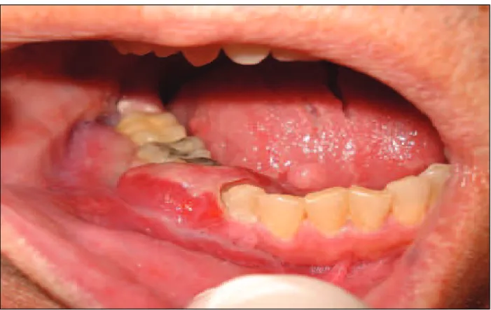 Figura  2  –  Aspecto  intrabucal  da  lesão,  demonstrando  inversão  do  fundo  de  vestíbulo  e  extensão sobre as coroas dos dentes 43 a 45