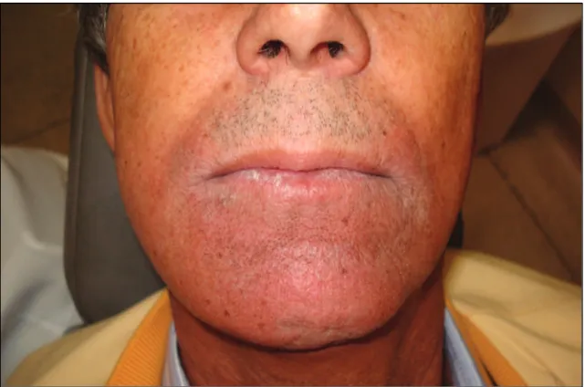Figura 8 –Aspecto extra-bucal após radioterapia, mostrando evidente regressão do tumor