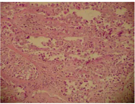 Figura 14a - Paciente de 32 anos com câncer ductal infiltrante e mastopatia fibrótica de mama direita (HE-400x) 