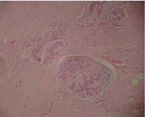 Figura 14b - Paciente de 32 anos com câncer ductal infiltrante e mastopatia fibrótica de mama direita (HE-100x) 