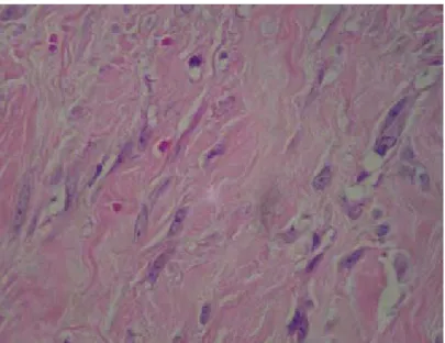 Figura 21 - Grande quantidade de fibroblastos epitelióides