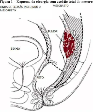 Figura 1 – Esquema da cirurgia com excisão total do mesorreto 