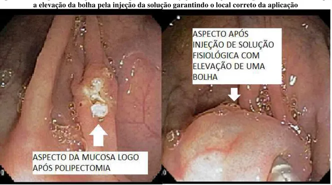 Figura 7 – Fotografia da injeção de nanquim dentro da bolha previamente formada por solução fisiológica 