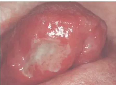 Figura 1 - Úlceras na superfície ventral da língua em paciente   com doença de Crohn. Fonte: Field, Allan, 2003