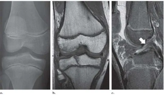 Figura 24:  Radiografia e Ressonância Nuclear Magnética, mostrando a morfologia  da fratura