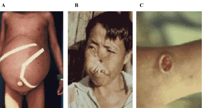 Figura 1. Formas clínicas de leishmaniose: visceral (A), muco-cutânea (B) e cutânea (C)