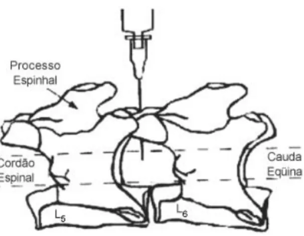 Figura  4.  Injeção  intratecal.  Inserção  da  agulha  no  espaço  subaracnoide  na  região  medial  entre  as  vértebras L5-L6