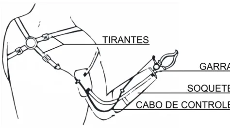 Figura 10: Exemplo de prótese acionada por tirantes. Adaptado de (Prosthetic &amp; Orthotic Care)