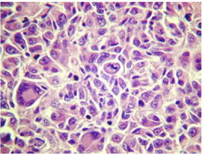 Figura 1. Aspecto histológico do melanoma. Fotomicrografia  do  tipo  histopatológico  mais  comum  de  melanoma  (epitelióide),  mostrando  formação  de  ninhos  celulares,  com  presença  de  células  gigantes  multinucleadas  e  figuras  mitóticas atípi