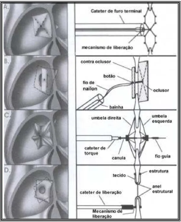 FIGURA 9. Evolução dos desenhos protéticos que precederam a prótese Amplatzer   e seus  respectivos sistemas de liberação