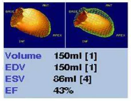 Figura 6 – Quantificação, através da Gated SPECT com MIBI- 99m Tc ao  repouso, do volume diastólico (EDV) e sistólico finais (ESV) e da fração de  ejeção do ventrículo esquerdo (EF) de um paciente do estudo após a terapia  de ressincronização, InCor – HCFM