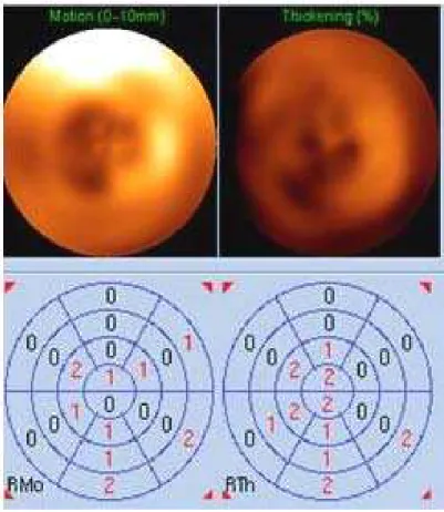 Figura 7 – Mapa polar da avaliação semiquantitativa do grau de  espessamento e motilidade de um paciente do estudo após terapia de  ressincronização