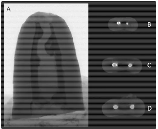 Figura 7 – Imagens de micro-CT, representativas do grupo ProTaper Retratamento pré desobturação