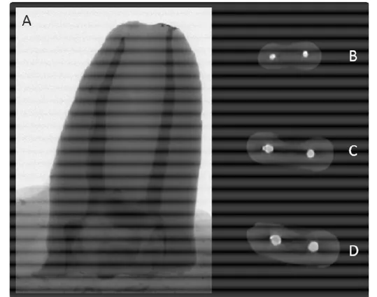 Figura 9 – Imagens de micro-CT, representativas do grupo ProTaper Retratamento com solvente pré  desobturação