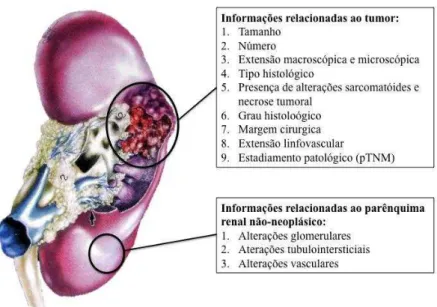 Figura  1  –   Recomendação  dos  parâmetros  a  serem  analisados  em  peças  cirúrgicas de nefrectomia radical pelo Colégio Americano de Patologistas