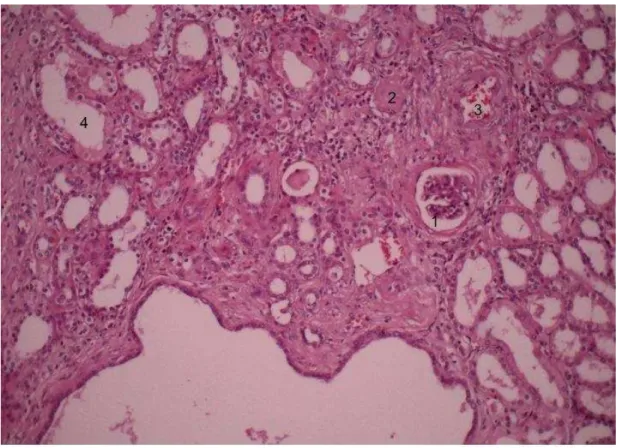 Figura  6  -  Lâmina  com  coloração  HE  (aumento  100X):  Presença  de  glomérulo com alteração inicial, com espessamento da capsula de Bowman  (1),  glomérulo  com  hialinização  e  esclerose  importante  (2),  arteriosclerose,  com espessamento da pare