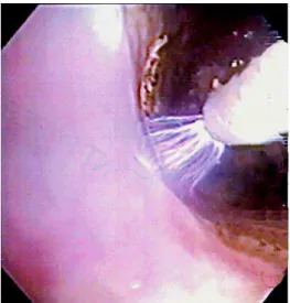 Figura 6. EB com metaplasia circular. 7 cm 