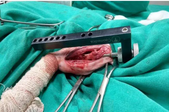 Figura 4: lmagem fotográfica transcirúrgica evidenciando implantação da haste intramedular  bloqueada (Setor de Cirurgia do Hospital Veterinário da UFU)