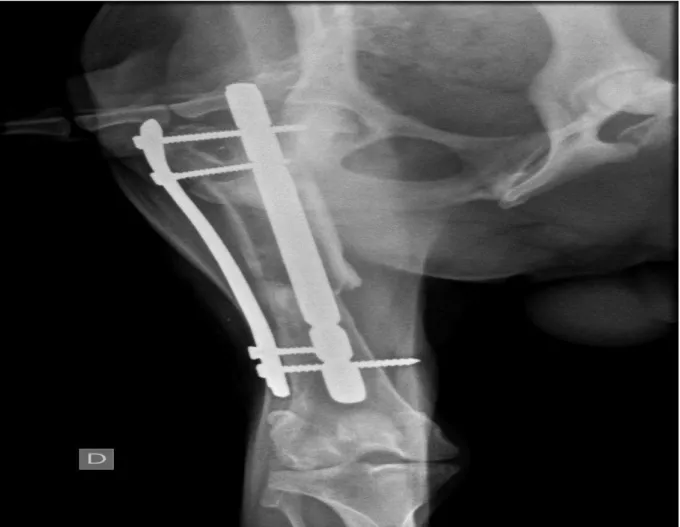 Figura 5: Imagem radiográfica do paciente Xulipa, para ilustrar o mau posicionamento do  implante, onde parte da haste intramedular bloqueda está deslocada para fora do canal medular e o 