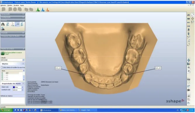 Figura 4. Mensuração dos espaços de extrações no programa OrthoAnalyzer TM  3D. 