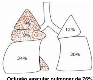 Figura 4. Representação esquemática do fluxo sanguíneo pulmonar e da                  intensidade de sobrecarga hemodinâmica pulmonar no grupo LII.