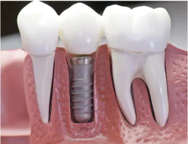 Figura 1 - Implantes Odontológicos feitos a partir de Titânio (Hospital Jório da Escóssia, 2018) 
