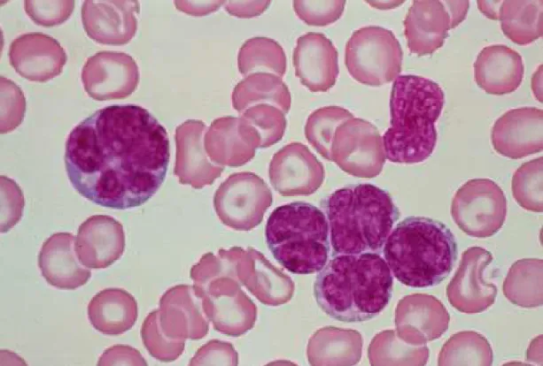 Figura  3.  Distensão  de  sangue  periférico  em  aumento  de  1000X  evidenciando  Flower  cell  de  paciente  com  ATL  forma  aguda,  acompanhado  no  Serviço  de  Hematologia  do  Hospital  das  Clínicas  da  Faculdade  de  Medicina  da  Universidade 