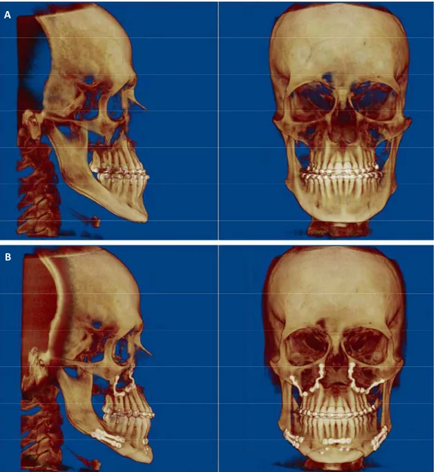 Figura 2 – Paciente no período pré e pós-operatório. A) Vista lateral e frontal no período T0
