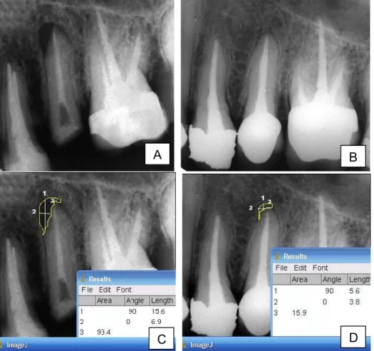 Figura 6 - Aspectos radiográficos do dente 25 referente ao paciente 17. 