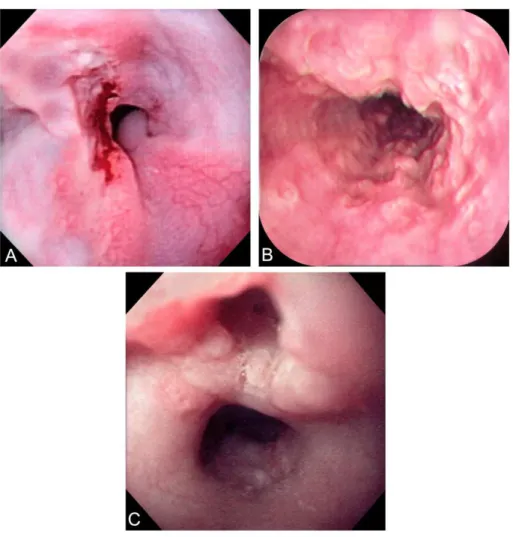 Figura 5:  Úlceras  esofágicas  A)  Inespecífica.  B)  Por  Histoplasmose.  C)  Por  PCM
