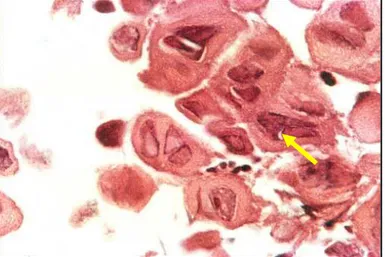 Figura 7:  Fotomicrografia  de  esofagite  herpética.  Células  multinucleadas  com  amoldamento  nuclear  (seta)