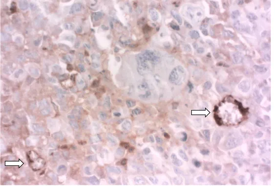 Figura  5  -  Fotomicrografia  de  corte  histológico  de  tumor  de  Ehrlich  sólido  em  animal  submetido  à  quimioterapia com bleomicina 