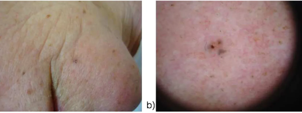 Figura 2 - Aspecto clínico do CBC nodular e pigmentado – Diagnóstico Dermatoscópico. 