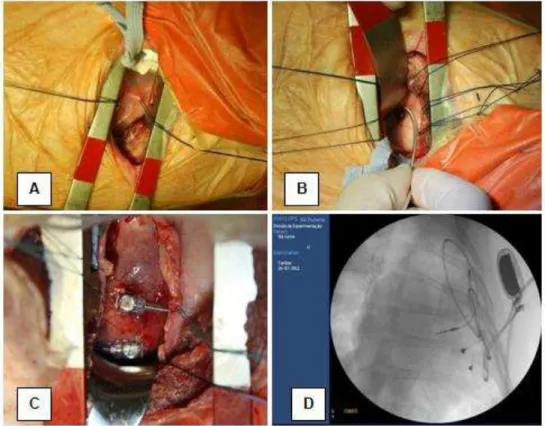 Figura  3  -  Principais  fases  do  implante  do  marcapasso:  A  =  abertura  do  pericárdio;  B  =  fixação  cabo-eletrodo  atrial;  C  =  fixação  cabo-eletrodo  ventricular; D = imagem fluoroscópica após implante do marcapasso 