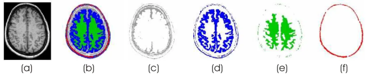 Figura 2.4: Exemplo de segmenta¸c˜ao realizada pela varia¸c˜ao do m´etodo EM/MPM. (a) imagem original; (b) imagem segmentada em 5 classes; (c) regi˜ao de classe 1 (fluido c´erebro-espinhal); (d) regi˜ao de classe 2 (massa cinzenta); (e) regi˜ao de classe 3