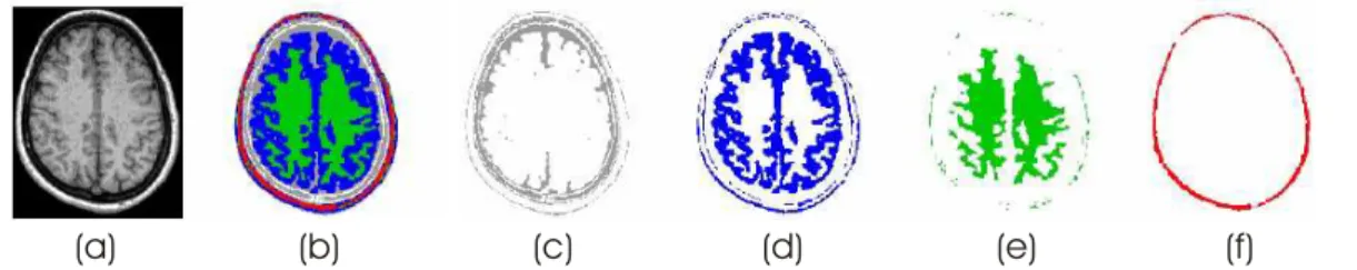 Figura 3.4: Exemplo de segmenta¸c˜ao realizada pela varia¸c˜ao do m´etodo EM/MPM. (a) imagem original; (b) imagem segmentada com L = 5; (c) regi˜ao de classe 1 (fluido  c´erebro-espinhal); (d) regi˜ao de classe 2 (massa cinzenta); (e) regi˜ao de classe 3 (