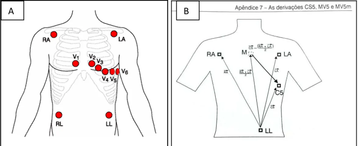 Figura  3.  A)  Monitoração  eletrocardiográfica:  RA  =  eletrodo  correspondente  ao  braço  direito;  LA  =  eletrodo  correspondente  ao  braço  esquerdo;  RL  =  eletrodo  correspondente à perna direita; LL = eletrodo correspondente à perna esquerda; 