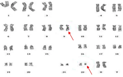 Figura  1  –   Cariótipo  de  paciente  com  LMC  indicando  a  presença  do  Cromossomo Philadelphia