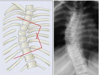 Figura 1: Representação da medida do ângulo de Cobb. Fonte: http://www.e- http://www.e-radiography.net/radpath/c/cobbs-angle.htm (acesso 11/12/12) 