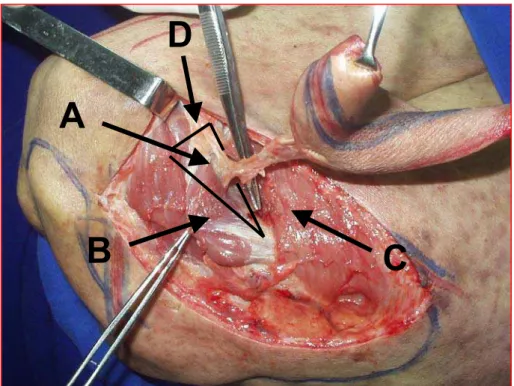 Figura 3 – Dissecção do pedículo vascular do retalho paraescapular. Nota-se  em A o pedículo vascular em seu trajeto através do espaço triangular na  região escapular