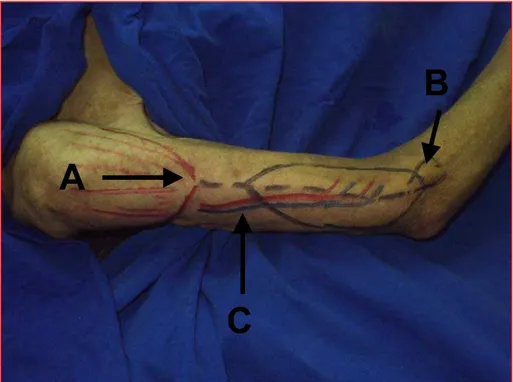 Figura 4 – Demarcação do retalho cutâneo lateral do braço. Nota-se em A  topografia do ponto de inserção do músculo deltóide, em B projeção do  epicôndilo lateral do úmero e em C a topografia do pedículo vascular do  retalho cutâneo (vasos colaterais radia