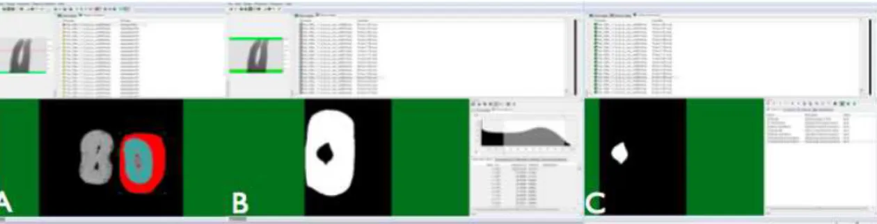 Figura  4.5  –  Programa  CTan:  Delimitação  da  região  de  interesse  (A);  binarização  da  imagem    (B) e utilização da ferramenta Custom Processing (C) 