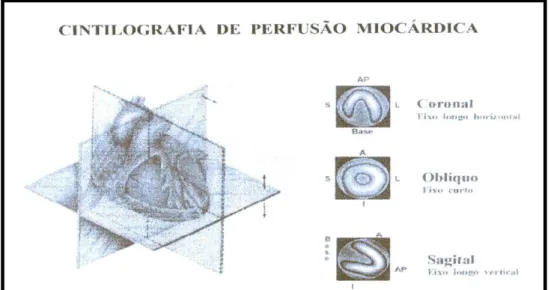 Figura 6.  Cintilografia de perfusão miocárdica:planos de reconstrução  tomográfica e respectivas projeções das regiões ventriculares