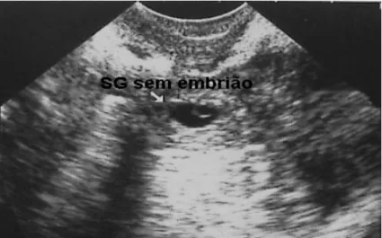 Figura 2 – Imagem de saco gestacional sem embrião à ultra-sonografia  transvaginal 