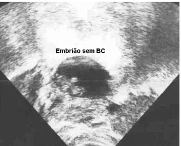 Figura 3 – Imagem de embrião sem batimentos cardíacos à ultra- ultra-sonografia transvaginal 
