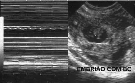Figura 5 – Imagem de embrião com atividade cardíaca à ultra- ultra-sonografia transvaginal 