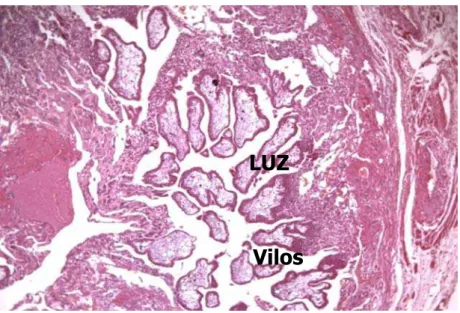 Figura 6 – Imagem histopatológica de tuba uterina acometida por GE: 