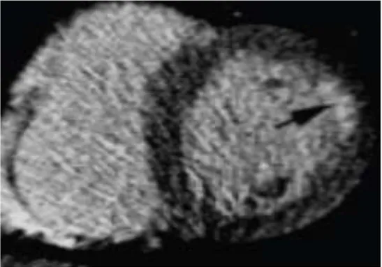 Figura 4: Realce tardio miocárdico pela tomografia. 